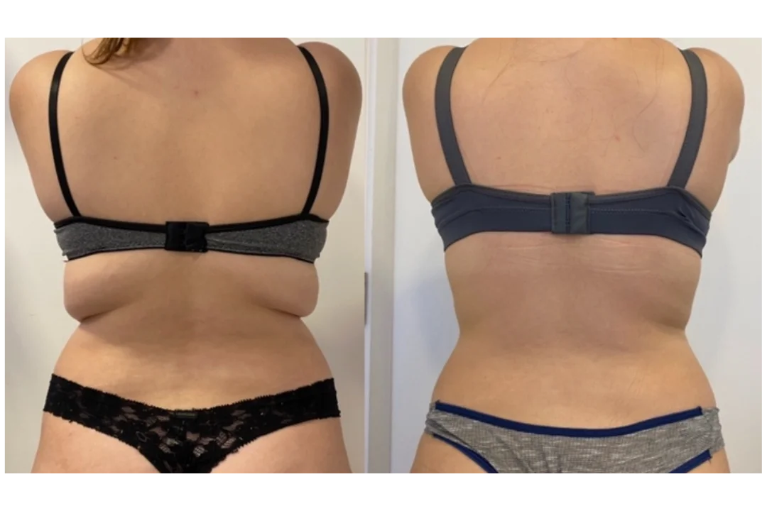 Antes e depois Crio Sessão Única — aluna 1