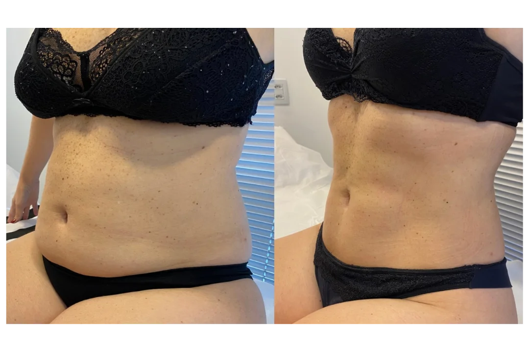 Antes e depois Crio Sessão Única — aluna 2